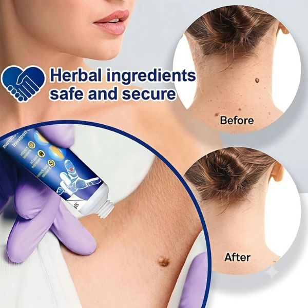 Wart remover ointment ingredients and texture