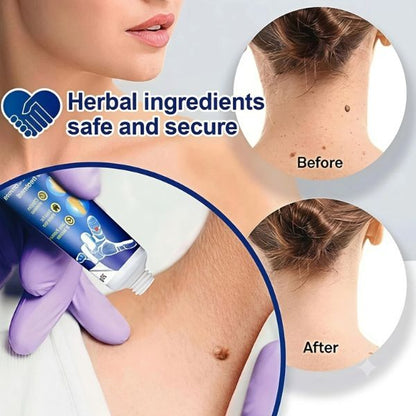 Wart remover ointment ingredients and texture