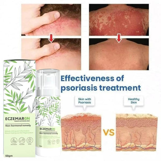MD Ecze+ Anti Fungal Spray - Doctor's Recommended 👨🏽‍⚕️ Buy 1 Get 1 Free Rating