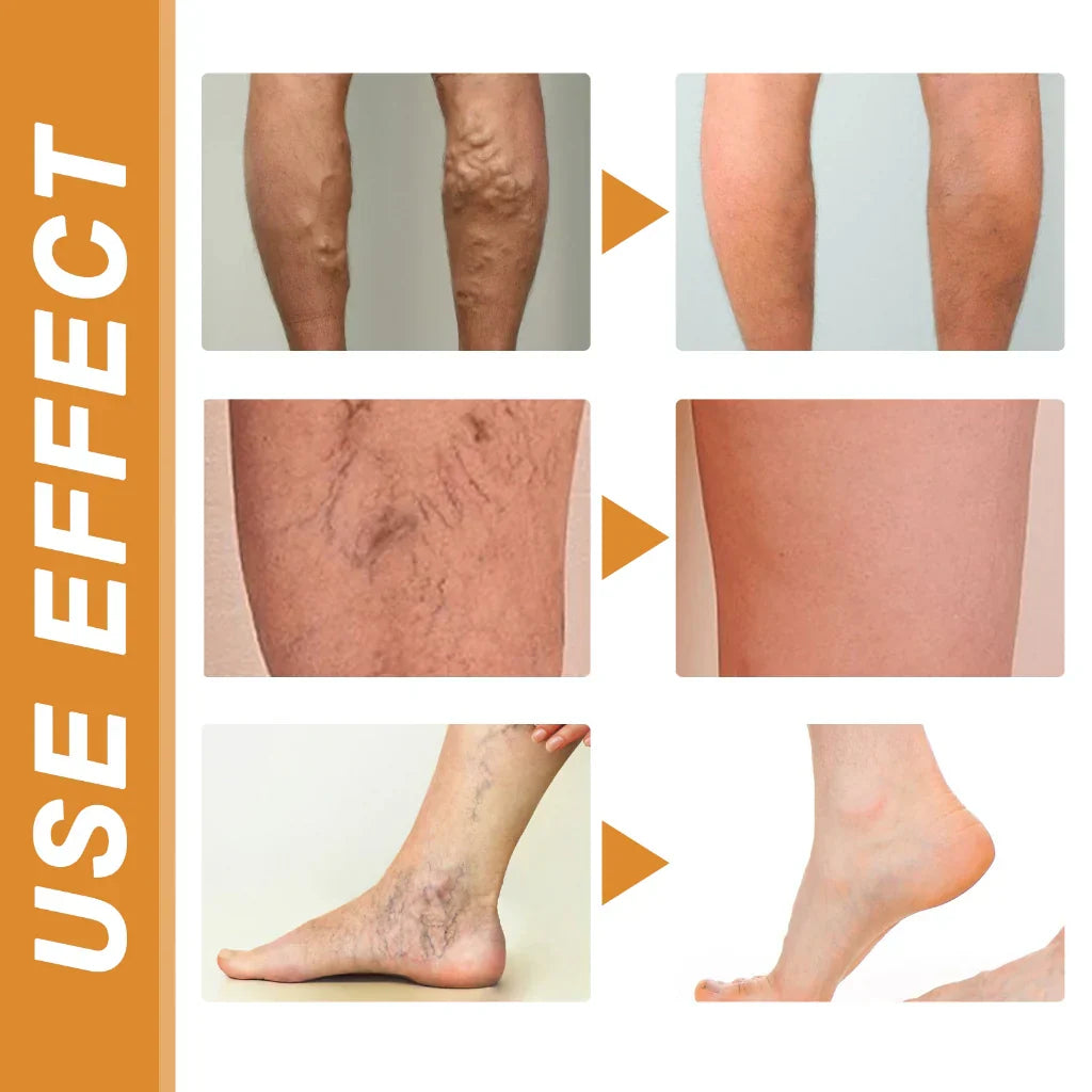 Turmeric Varicose Veins Relief Spray (BUY 1 GET 1 FREE)